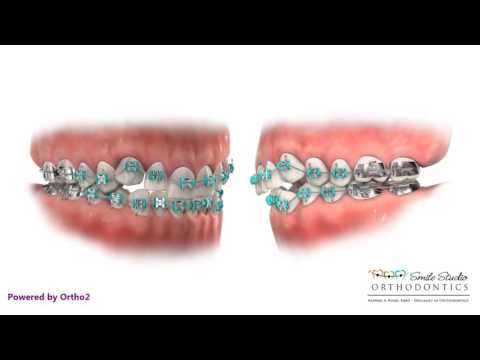 download lagu mp3 mp4 Braces For Overcrowding, download lagu Braces For Overcrowding gratis, unduh video klip Braces For Overcrowding