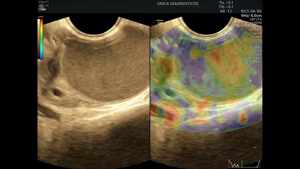Vídeos de exames de endometriose Pt. 4