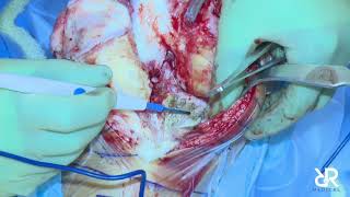 Dr. Stefan Kreuzer performs Total Knee Arthroplasty using the Think Surgical Robot | TCAT (No Audio)