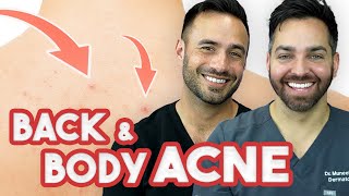 BACK ACNE - How to Treat and Prevent It | Doctorly Routines