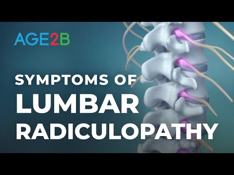 What Are the Symptoms of Lumbar Radiculopathy? | Spinal Nerve Root Pain | Disc Bulge