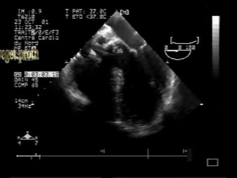 Infective Endocarditis On aortic Mechanical Prosthesis With Aortic Abscess