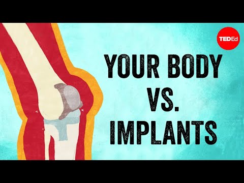 Why Medical Implants Have to Be Replaced Regularly