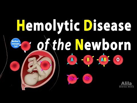 Hemolytic Disease of the Newborn (HDN), Animation