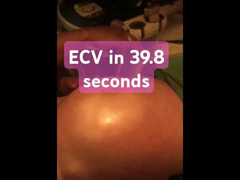 ECV in 39.8 seconds. Super Soft Touch ECV for Breech Baby. External Cephalic Version.