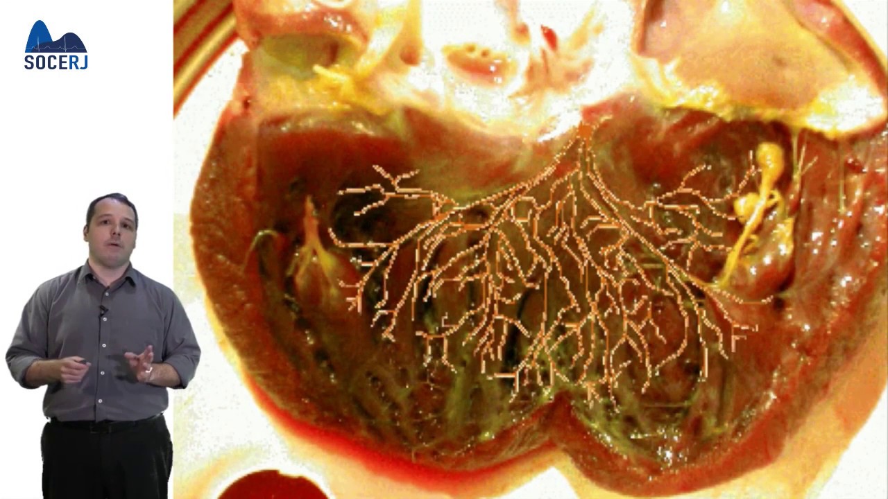 Curso Básico de ECG - Aula 05:  Bloqueios de Ramo