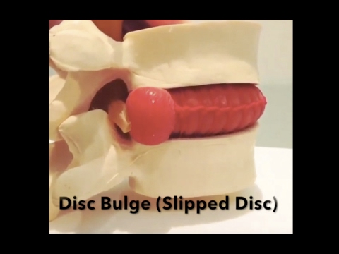 Disc Bulge