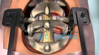 3D Medical Animation | Lumbar spine surgical procedure.  2 level fusion of L4-S1