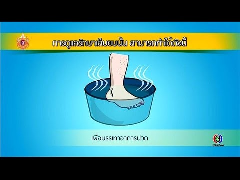 แปลมาจากภาษาละตินกลาก Kartalin ครีมกลาก