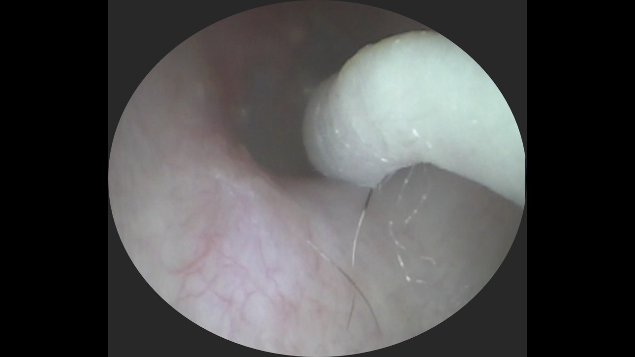 Vol.339【耳掃除】UP希望☆7年ぶりの再来店‥お耳のなかの“居座り猫ちゃん”に苦戦中！？～eariss