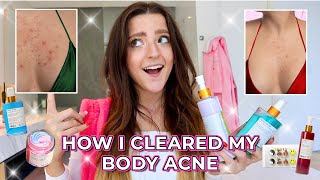 The TRUTH About Getting Rid of Body Acne For GOOD | My Truly Beauty Experience