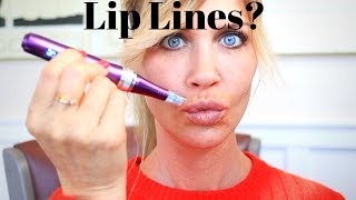 Liplines? Here&#39;s what I am doing to treat mine.