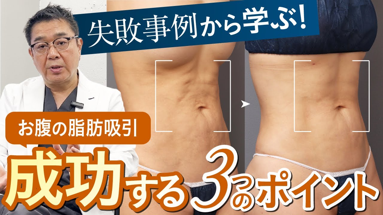 脂肪吸引で失敗しないために必要なことは?専門医が徹底解説!