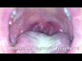 Clinical Quiz: sore throat 