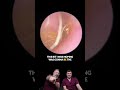 Three Clinics One Hair Ear Wax Removal Frustration Ends Here