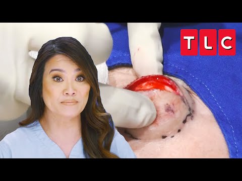 Dr. Lee Squeezes “Devil Horn” Cyst off the Forehead of a Patient | Dr. Pimple Popper | TLC