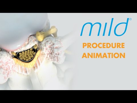 Mild Procedure Animation | Lumbar Spinal Stenosis (LSS) Treatment