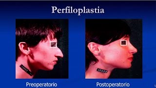 Perfiloplastia: nariz y barbilla