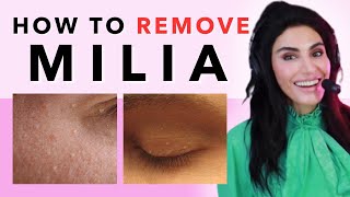 How to REMOVE MILIA and Under Skin Bumps | More Than A Pretty Face Podcast