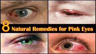 How to Get Rid of Pink Eye Fast at Home - 8 Home Remedies for Eye Infection