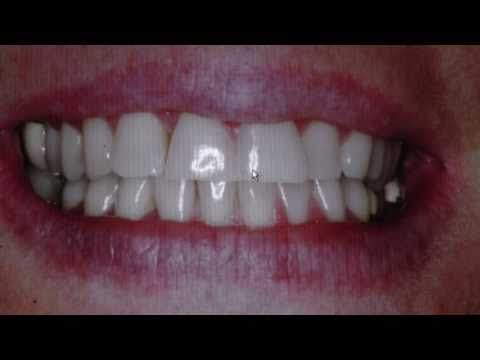 Smile Design at the office of Dr. S. John Salivonchik