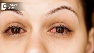 How to get relief from Burning Eyes? - Dr. Sriram Ramalingam