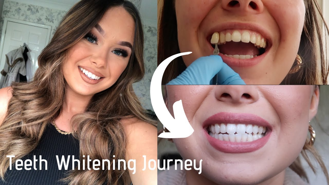 My Teeth Whitening Journey | during COVID | Zoom Nite White | Lumiwhite