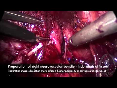 Laparoscopic Radical Prostatectomy - Intrafascial Nerve Sparing Technique 
