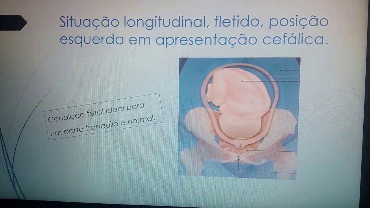 Estática Fetal -posições do feto na pelve materna. #estáticafetal.