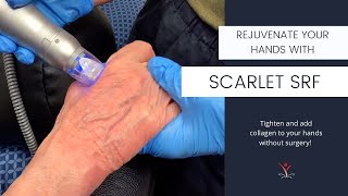 Tighten and Add Collagen to Your Hands Without Surgery