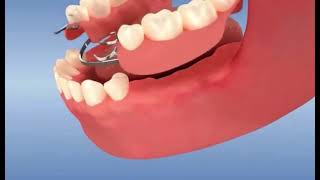 Prothèse amovible dentaire partielle, le dentier avec crochets