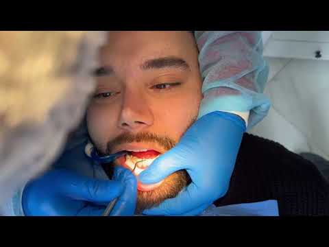 Composite veneer procedure at HABA dental clinic by Dr.Amir Azarsa