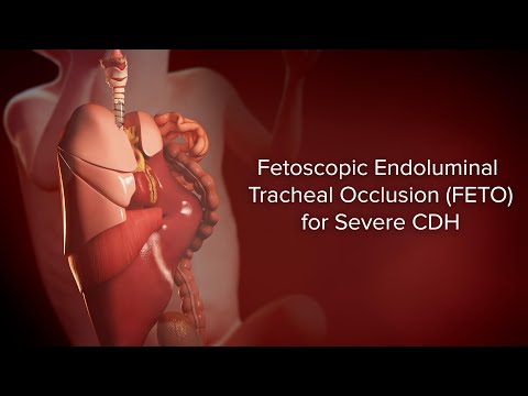 Fetoscopic Endoluminal Tracheal Occlusion (FETO) for Severe CDH