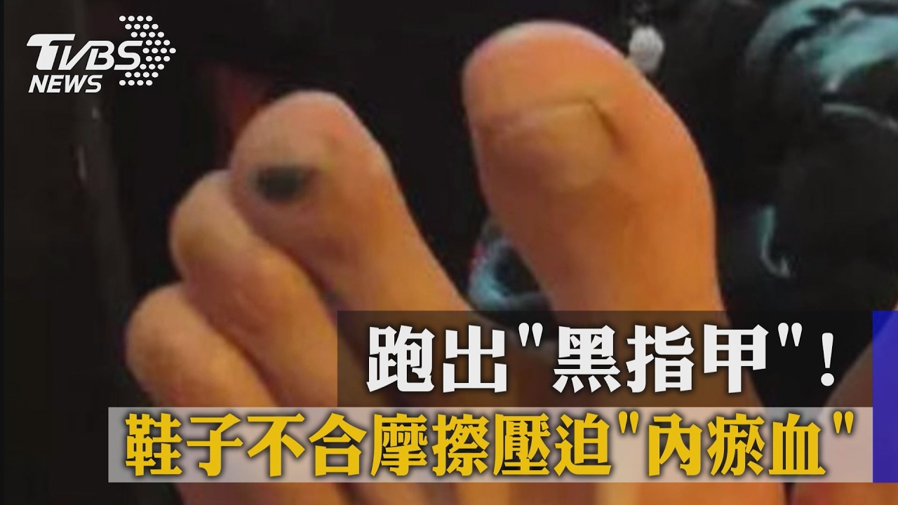 跑出黑指甲！鞋子不合　摩擦壓迫內瘀血
