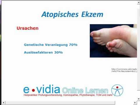 Für welche Zeit die Schuppenflechte geht Wie auch als behandelten die Schuppenflechte die Räte und die Antworten