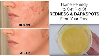 Home Remedy to get rid of REDNESS or RED SPOTS from your face || Mamtha Nair