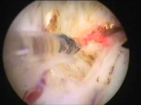 Holmium Laser Enucleation of Prostate