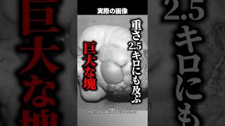 【50万人に1人】18年間体内で成長した『謎の塊』→世界でも極めて稀な症例『胎児内胎児』とは #shorts