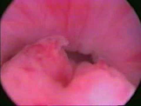 Wie mit BPH ohne Operation leben Wie viel des Prostata