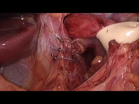 Why The Nissen-Hill Hybrid is Better Than Nissen Fundoplication from the SAGES Video Library