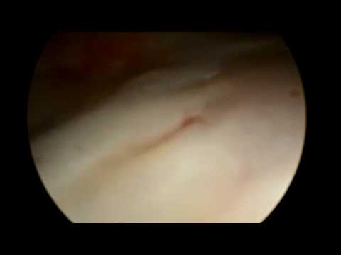 Zdwojone moczowody - cystoskopia