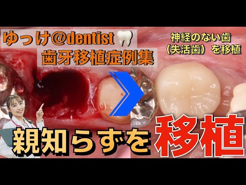 生命歯学科 【歯牙移植症例集】親知らずを使った歯の移植🦷親知らずにより抜歯宣告された歯が生まれ変わる‼️歯を残す治療「自家歯牙移植」🦷今回は「失活歯ドナーの抜歯後待機歯牙移植」を大公開❗️