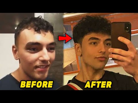 The Meat And Potatoes Hair Loss Prevention Stack - Before And After