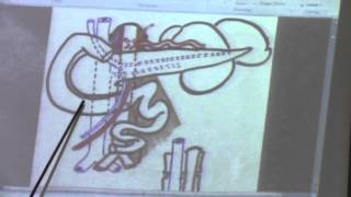 16-[Abdomen]  30-3-2016( IVC)(lymph nodes and cistern chyli)