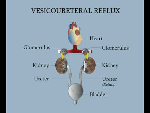 Vesicoureteral Reflux