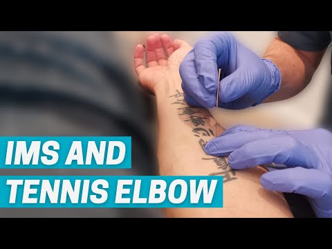 How can IMS Dry Needling help treat Tennis Elbow?