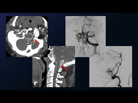 Far Lateral Craniotomy for Clip Ligation of a Marginal Sinus Dural Arteriovenous Fistula
