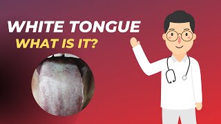 What is white tongue? | White tongue causes | Home remedy for tongue infection | Oral thrush