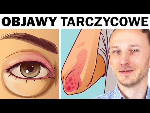 Wczesne i późniejsze objawy chorej tarczycy. Masz je Zrób te badania