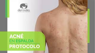 EL PEELING ULTRASÓNICO: EL TRATAMIENTO REVOLUCIONARIO PARA EL ACNÉ EN ESPALDA